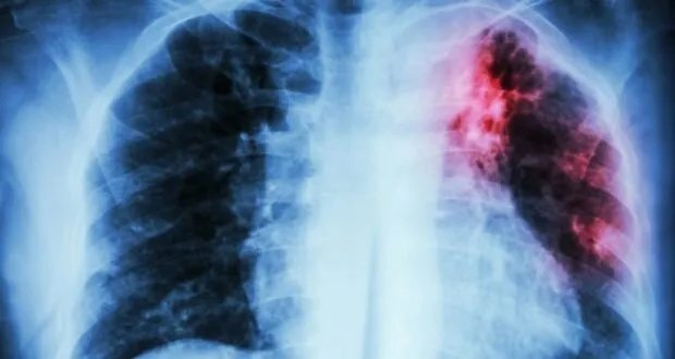 الصحة العالمية تحذر: السل يودي بحياة أكثر من مليون شخص في عام واحد