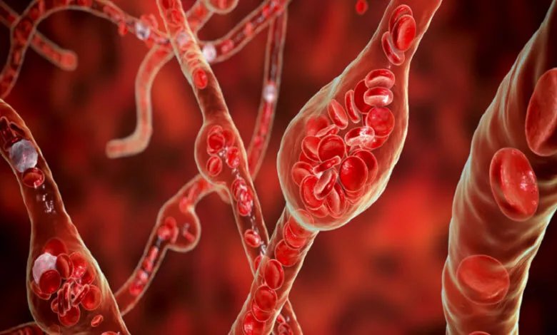 إنذارات مبكرة وأسباب شائعة: كل ما تحتاج معرفته عن ارتفاع الكوليسترول