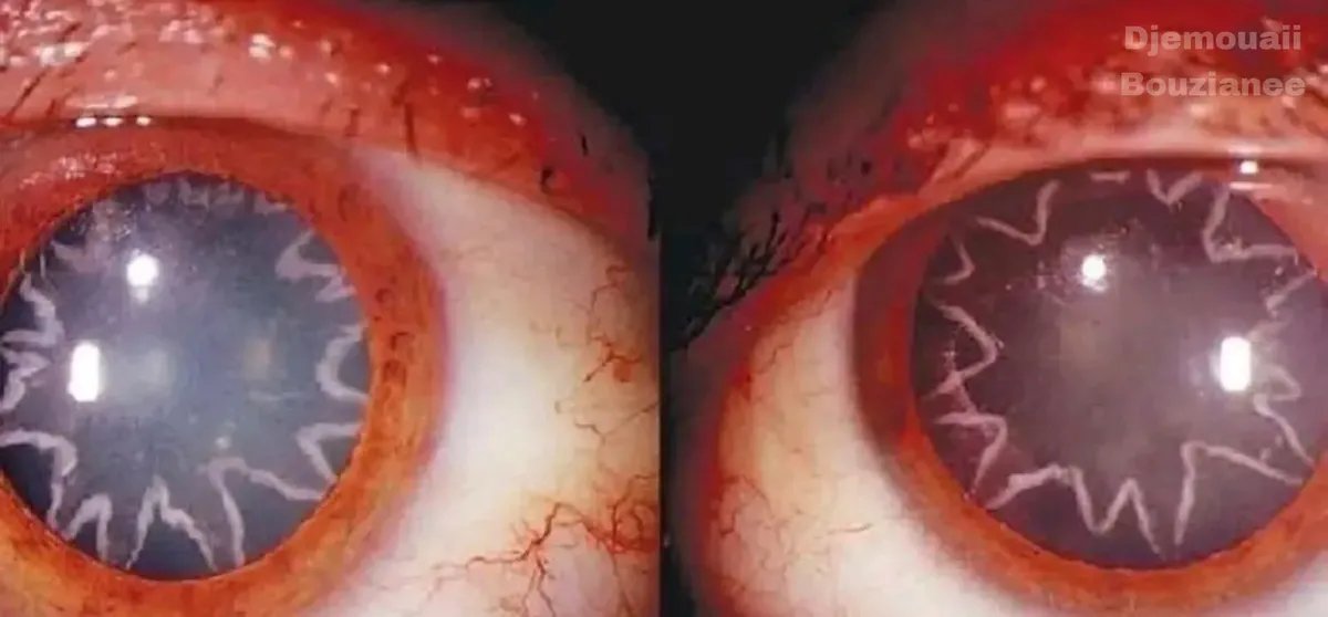 حادث مروع: صدمة كهربائية بـ14 ألف فولت تحول عين عامل إلى "نجمتين"