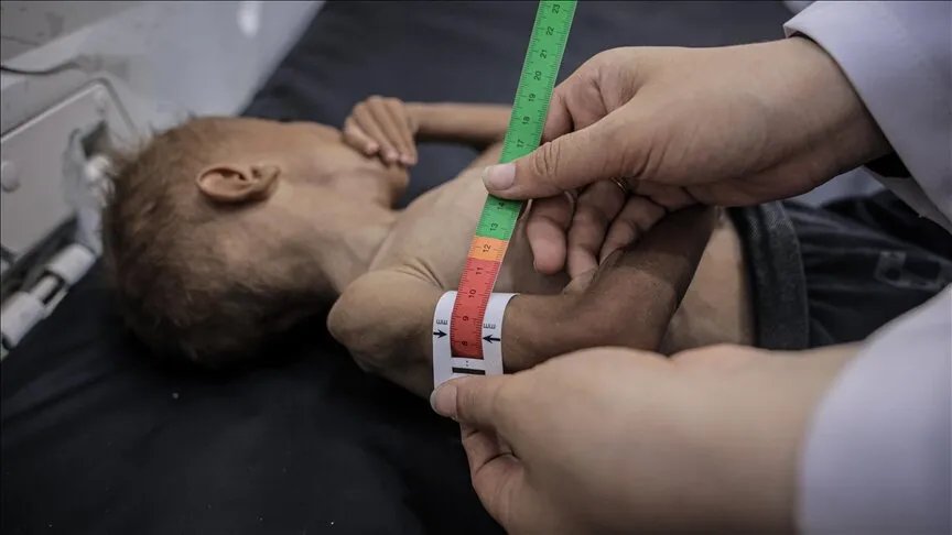 تحذير من اليونيسف: سوء التغذية الحاد يهدد حياة 9 آلاف طفل في غزة