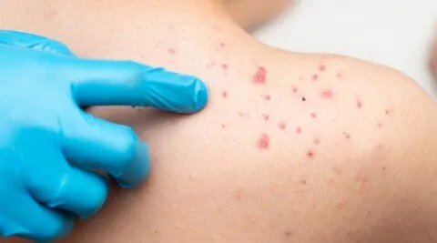 وداعاً لحب الشباب على الظهر والكتفين: المقشرات هي الحل الأمثل لبشرة صافية