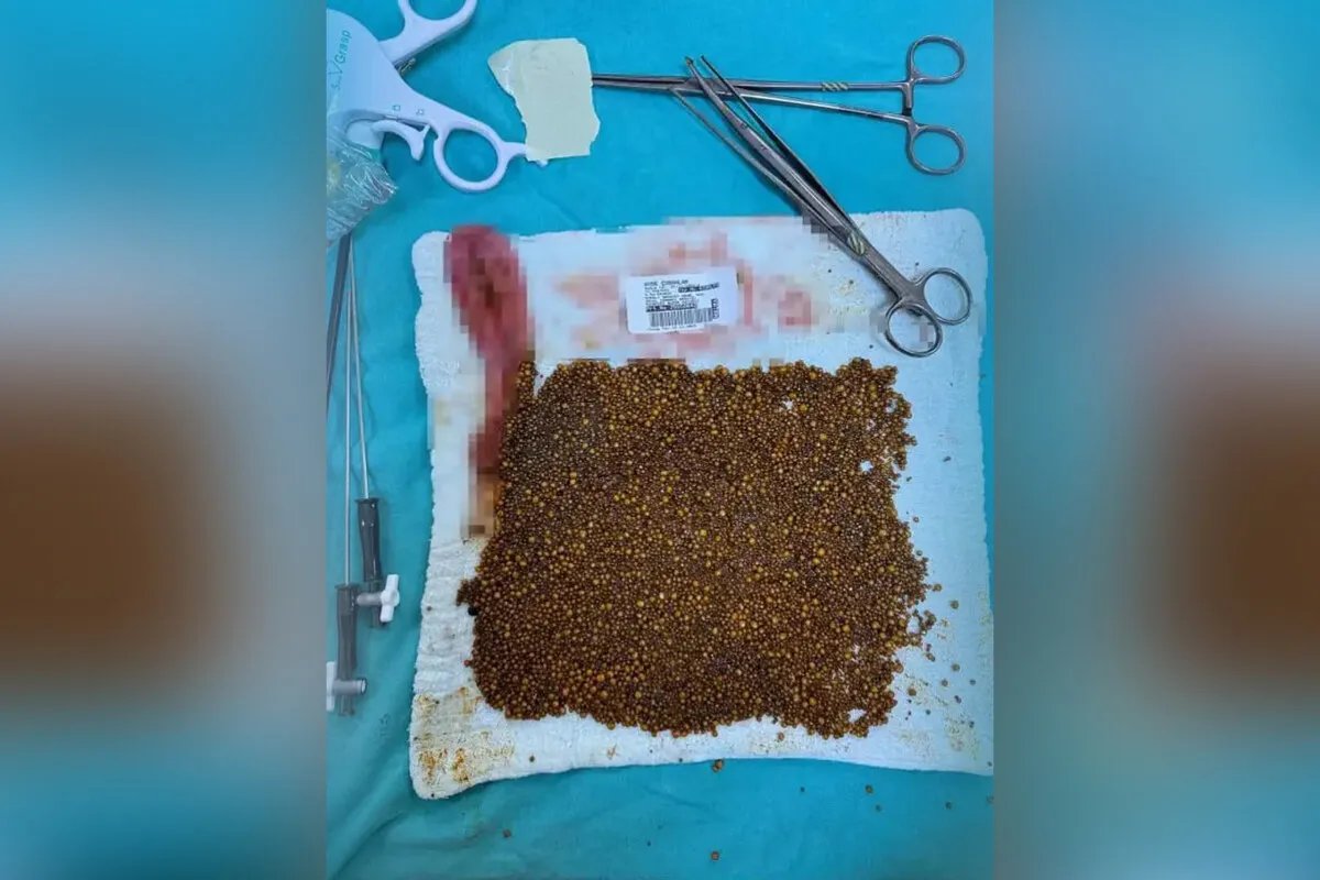 إنجاز طبي نادر: فريق تركي يستخرج أكثر من 20 ألف حصوة من مرارة سيدة سبعينية في مانيسا